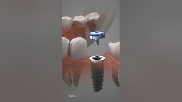 Dental Implant Procedure