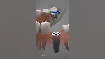 Dental Implant Procedure 