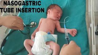 Nasogastric ( NG ) Tube Insertion In Neonate | Orogastric Tube | Feeding Tube