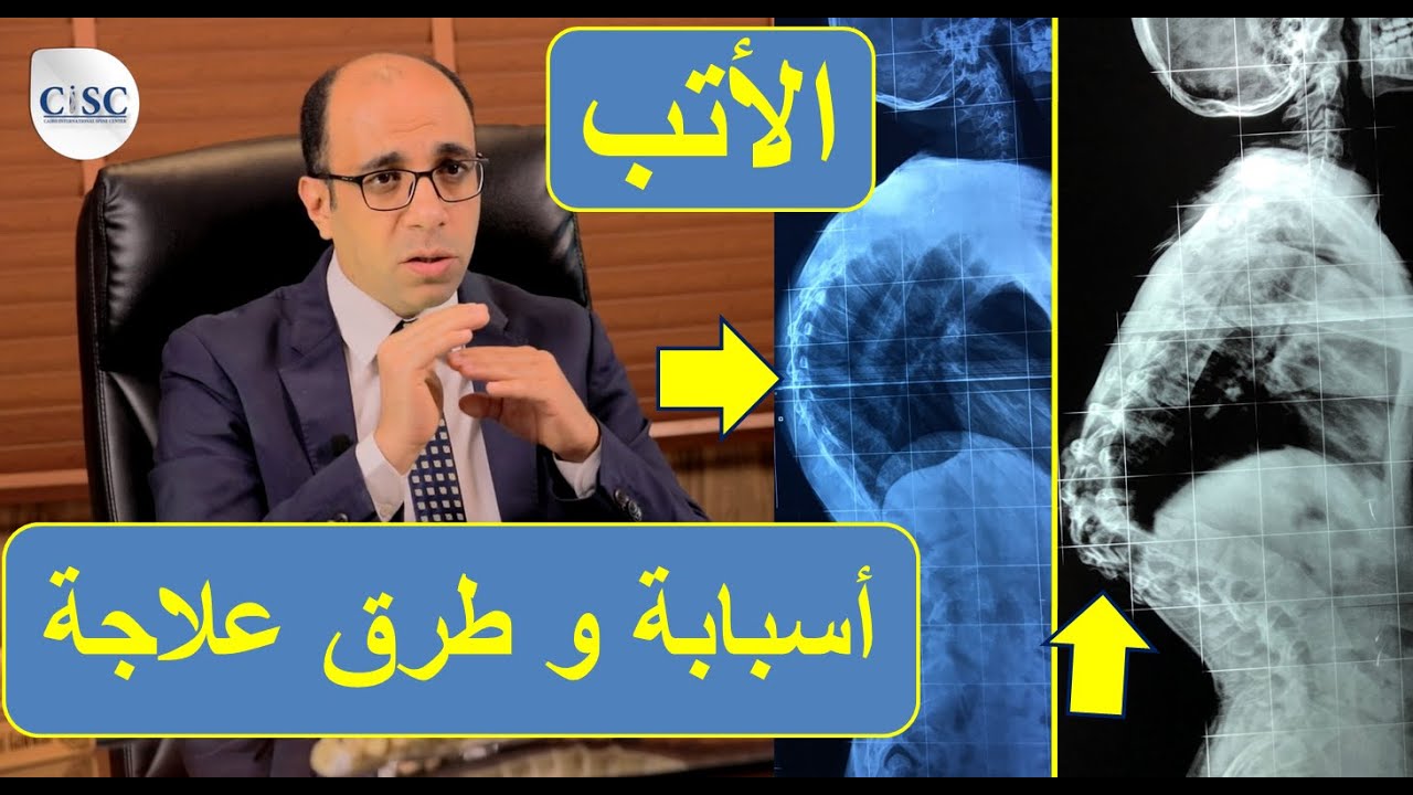 الأتب او تحدب العمود الفقري: أسبابة و طرق علاجة - YouTube