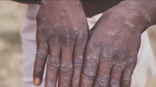 LA County confirms first case of monkeypox in a healthcare worker