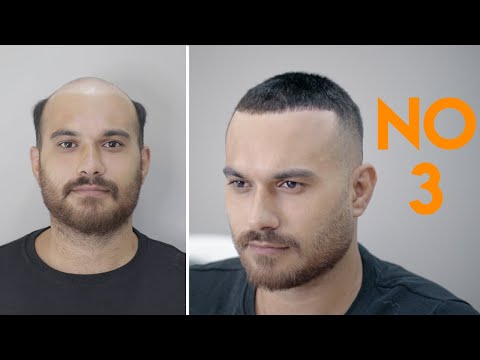 PROTEZ SAÇ - 3 NUMARA SAÇ KESİMİ - Hair Replacement