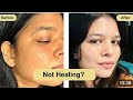 LIVE Q&amp;A: Damaged Skin Barrier | How to Stop Redness, Burning &amp; Heal Faster