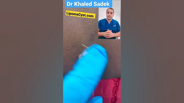 what is this? #shorts #cystremoval #skincare #pimplepopper  Dr Khaled Sadek Lipomacyst.com
