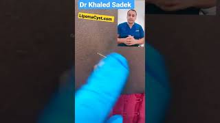 what is this shorts cystremoval skincare pimplepopper  Dr Khaled Sadek 