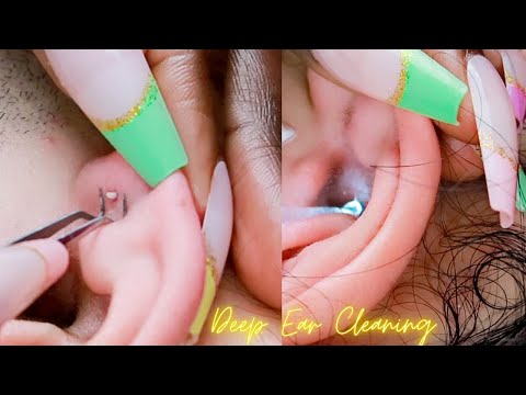 ASMR| Rare Deep Ear Cleaning & Picking ALL-ZOOMED ~ soft whispers 😴