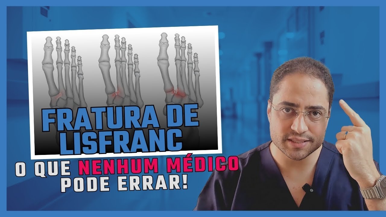 Fratura de Lisfranc - Sistemática de Análise para Não Negligenciar Fraturas