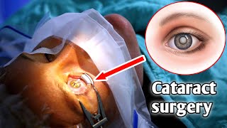 شاهد عملية ازالة المياة البيضاء من علي العين (الكتاراكت) _ Cataract surgery screenshot 5