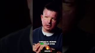 Burn Survivor: My Torturous Journey Through Scarring &amp; Vision Loss #shorts