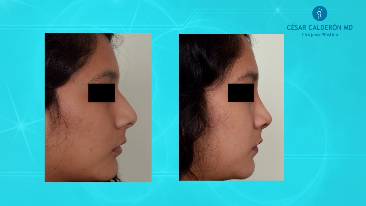 22 RINOPLASTIA ANTES Y DESPUÉS - YouTube