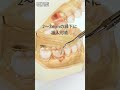 【細いチップが苦手な方へ】太くても歯間・縁下2~3mmに挿入可能 #超音波スケーラーチップ