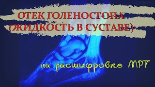 РАСТЯЖЕНИЕ СВЯЗОК голеностопа (отек и ЖИДКОСТЬ В СУСТАВЕ) на РАСШИФРОВКЕ МРТ голеностопного сустава