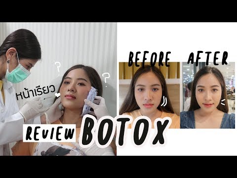 𝑹𝒆𝒗𝒊𝒆𝒘 ฉีดโบท็อกซ์💉 sowon clinic หน้าเรียวขึ้นจริงมั้ย | faiichada