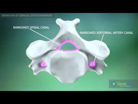 Video: Chondroprotectors For Osteochondrosis Of The Spine: A List Of Effective