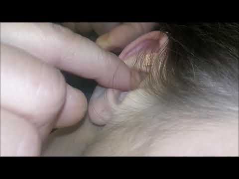 Vacumterapia Auriculoterapia Nutricionista Contra La Celulitis 