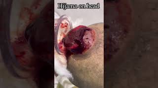 Cupping On Head 🤯🥸|Gujarat Hijama Therapy |#हिजामा #shorts screenshot 5