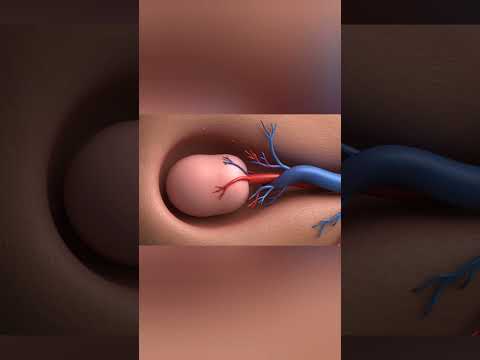 Testicular Torsion A Medical Emergency In Motion 