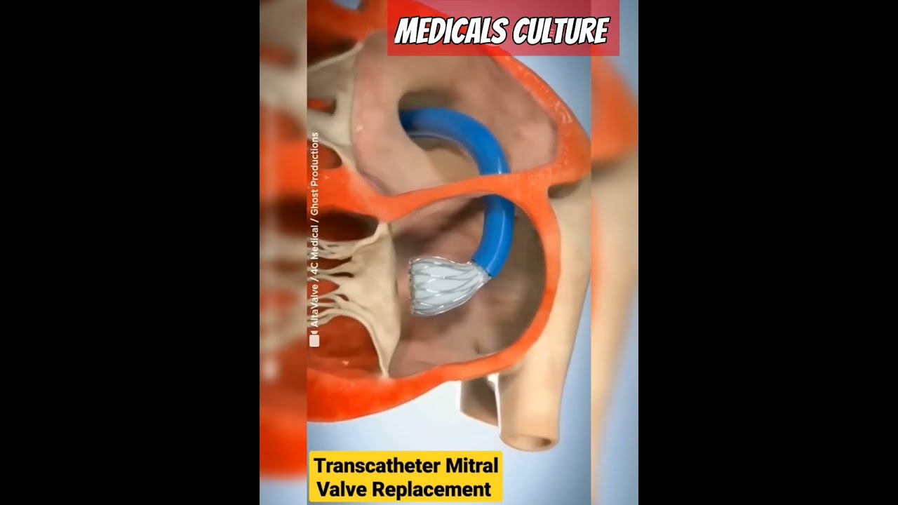 Altavalve Transcatheter Mitral Valve Replacement TMVR Shorts Medical Animation Youtubeshorts