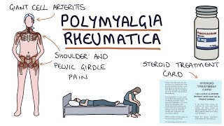 Polymyalgia Rheumatica: Visual Explanation for Students