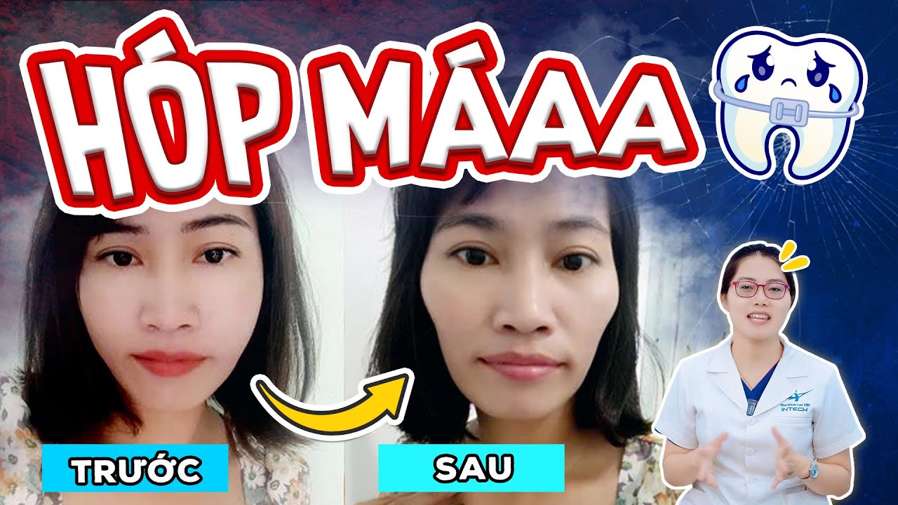 Outline Video Niềng Răng Bị Hóp Má: 3 Điều Cần Phải Biết Để Không Bị Hóp Má Khi Niềng Răng, Đặc Biệt Là Điều Số 2