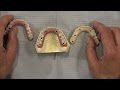 Case of the week: The Fabrication and Delivery of BruxZir Full- Arch Implant Prosthesis