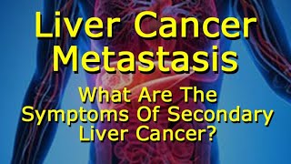 Liver Cancer Metastasis: What Are The Of Secondary Liver Cancer? screenshot 5