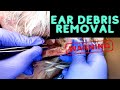 Insane ear debris debulking  contour dermatology