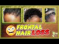 How to restore thinning edges (Part 1/2) | NATURAL HAIR