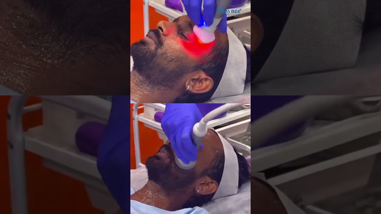 Carbon laser facial procedure at Maynee Skin Clinic Chennai — click to play