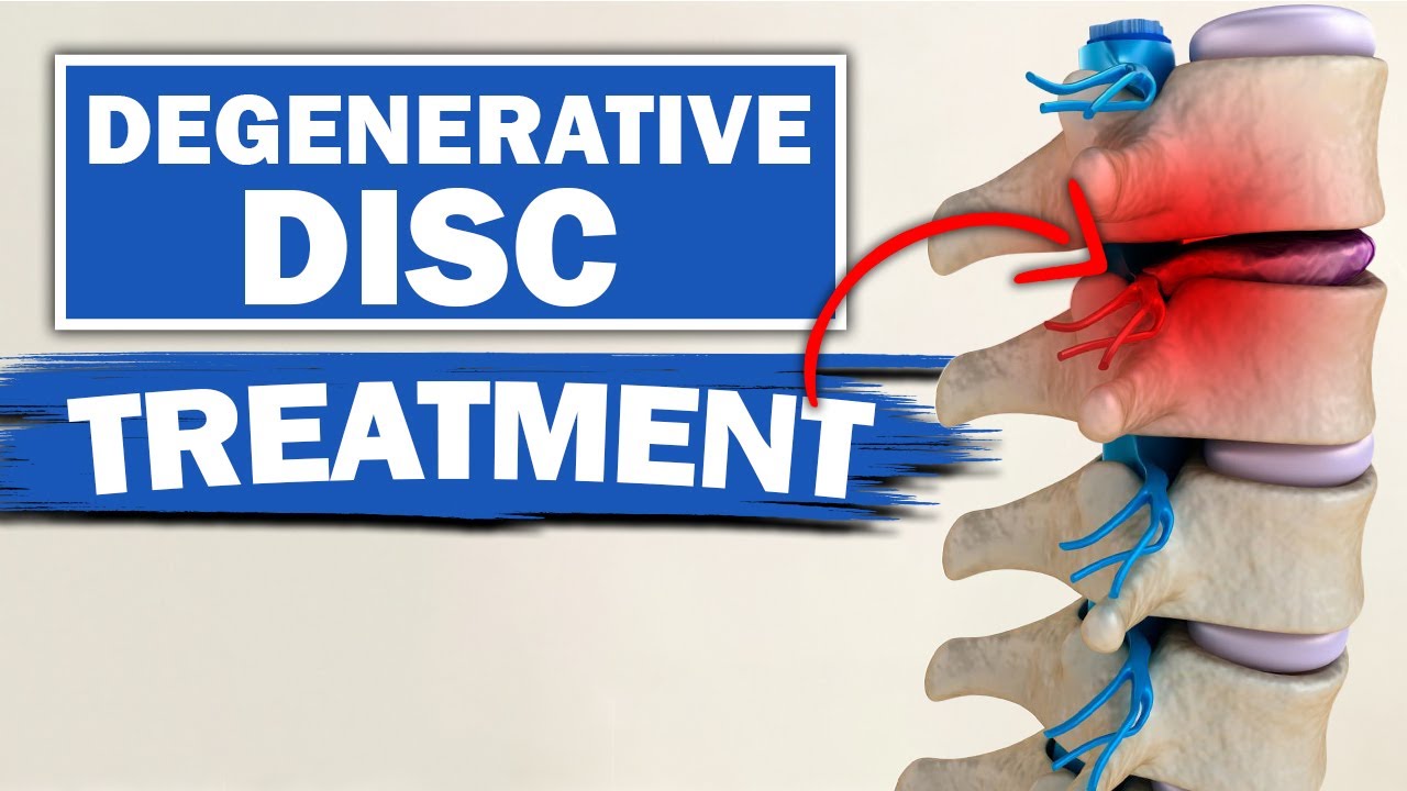 Degenerative Disc Disease Treatment 2 Best Exercises YouTube Degenerative Disc Disease Treatment 2 Best Exercises YouTube