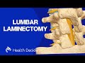 Lumbar Laminectomy - 3D Animation