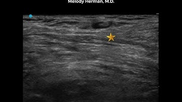 Suprainguinal Fascia Iliaca Block