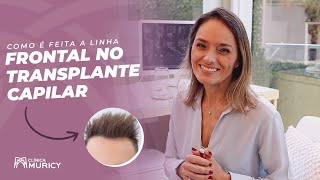 Posição Da Linha Frontal No Transplante Capilar