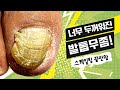 눈으로 서서히 보이는 새 발톱 성장 (eng) / Thick Toenail Scaling / 🎁EVENT 진행중🎁