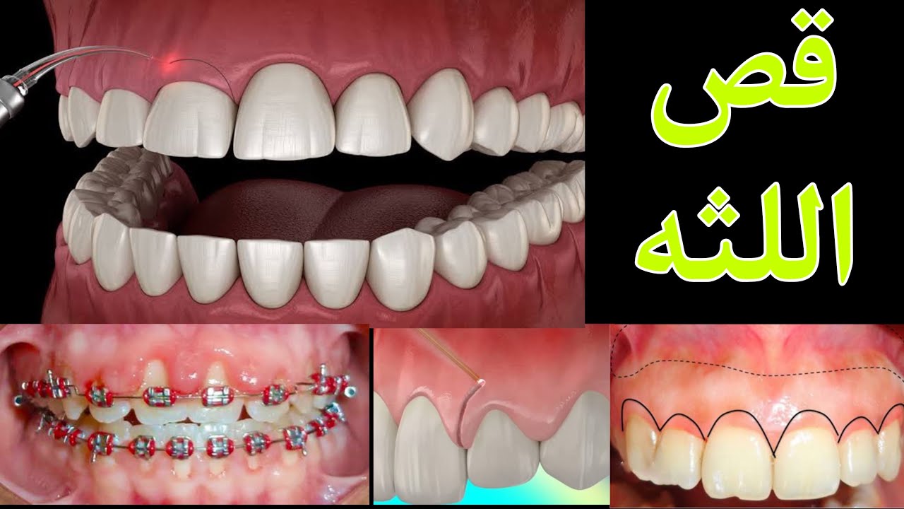قص اللثه مع تقويم الاسنان | الابتسامة اللثوية كيف يتم علاجها و متى ؟