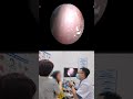सालों पुराना Earwax Build-Up हटाया गया 😱 #EarCleaning #Healthcare #कान
