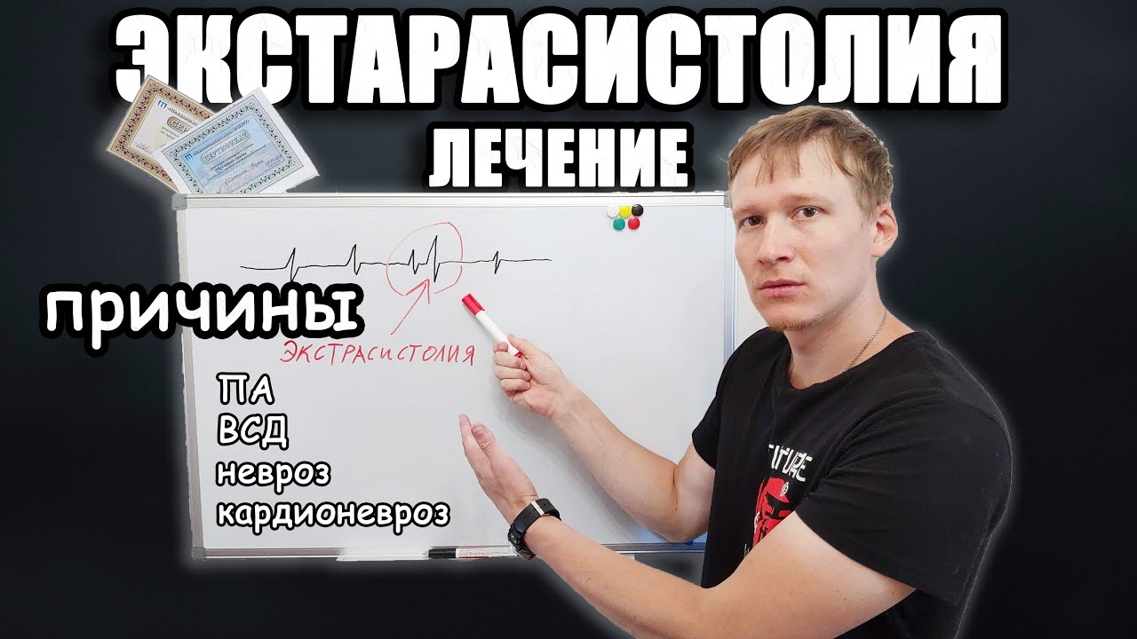 Экстрасистолия экг | Экстрасистолия при неврозе и всд замирание сердца.