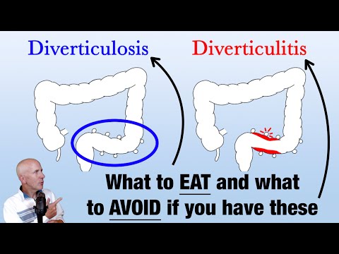Diverticulitis: What to eat