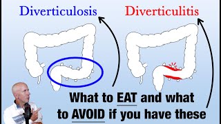 Diverticulitis What To Eat