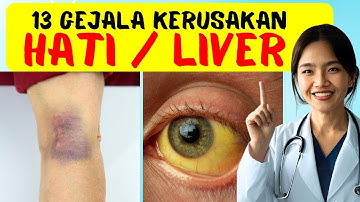 13 Gejala Rusaknya Hati / Liver yang Sering Diremehkan – Waspadai Sebelum Terlambat!