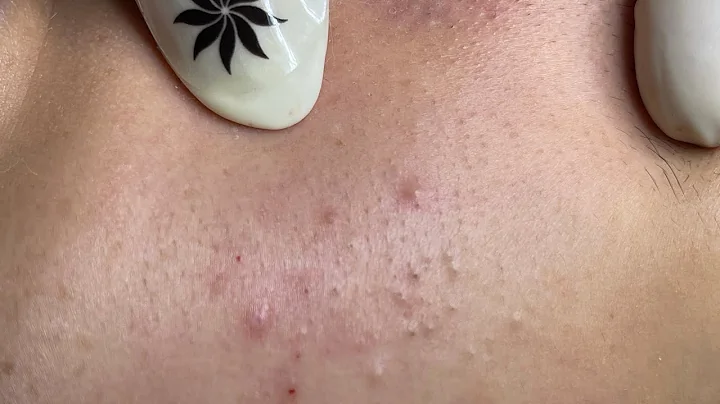 Relaxing Acne Treatment #165(Linh My Dang)