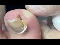 Super curved nail
