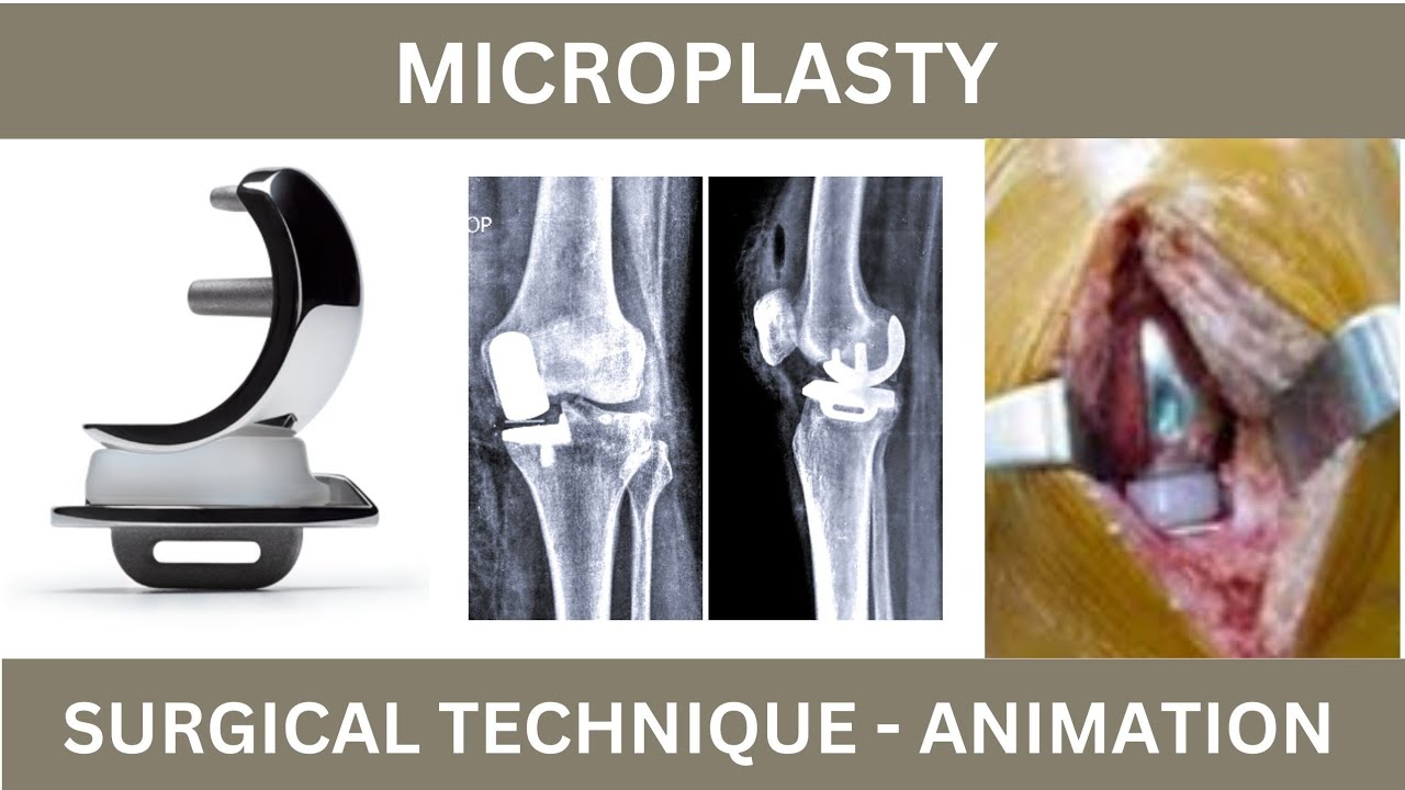 Microplasty Surgical TECHNIQUE Animation Zimmer Biomet Oxford