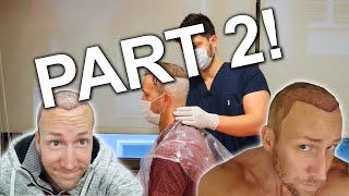 2020 FUE DHI 3200 Graft Hair Transplant From US to Turkey DELTA ONE Dr. Cinik PART 2