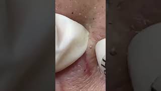 acne blackhead pimple satisfying blackheads pimpleremoval fyp  ID Video 7244868947521064219