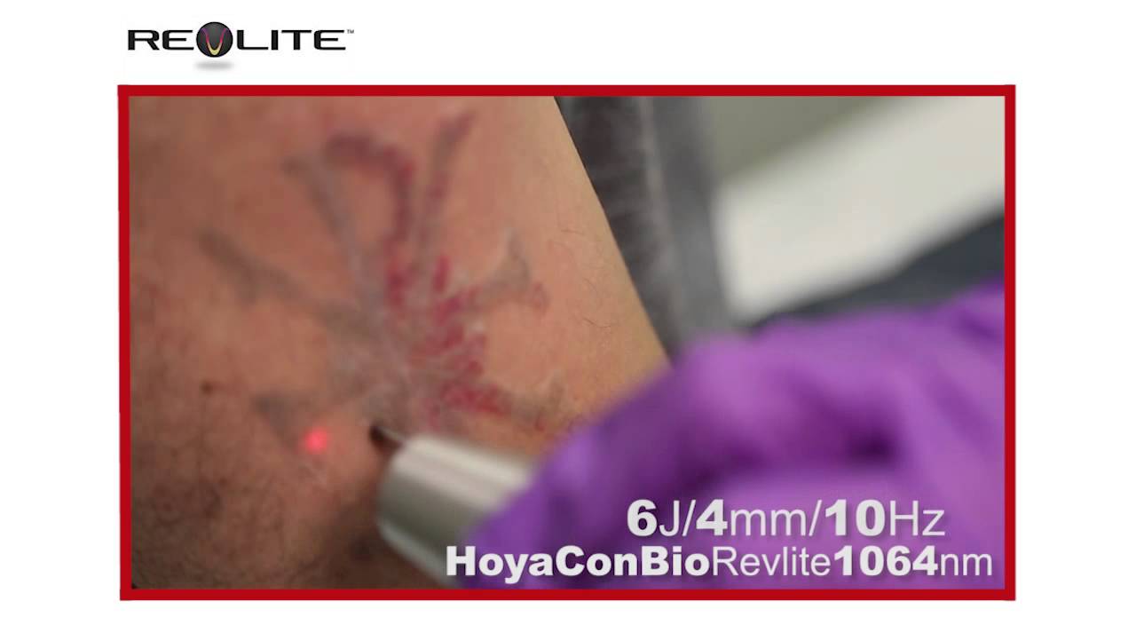 Spectra Tattoo Removal Clears Away Rivals. YouTube