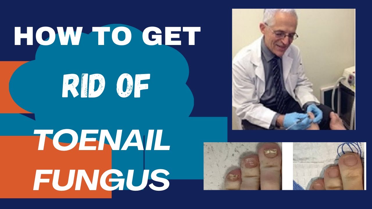 3 Simple Home Remedies for Toenail Fungus | Everyday Roots