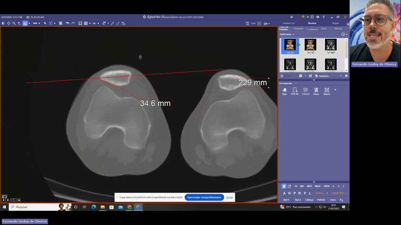 Você sabe o que é TAGT, altura e tilt patelar na Tomografia Computadorizada?