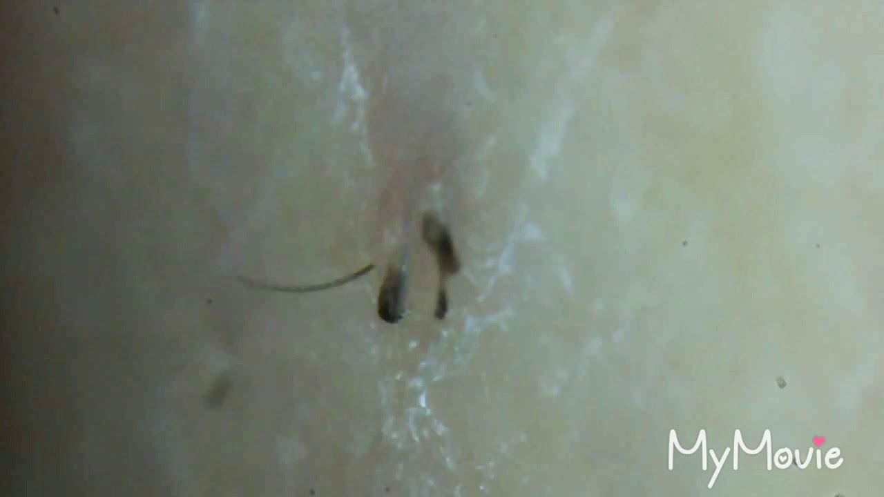 Compilation Of Slimy And Gross Ingrown Hairs And Plucking Today S