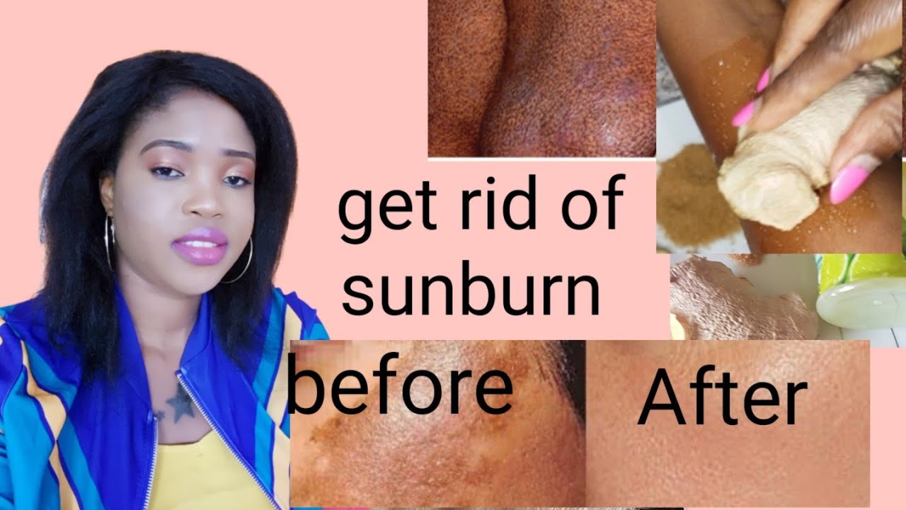 How to get rid of sunburn fast - YouTube